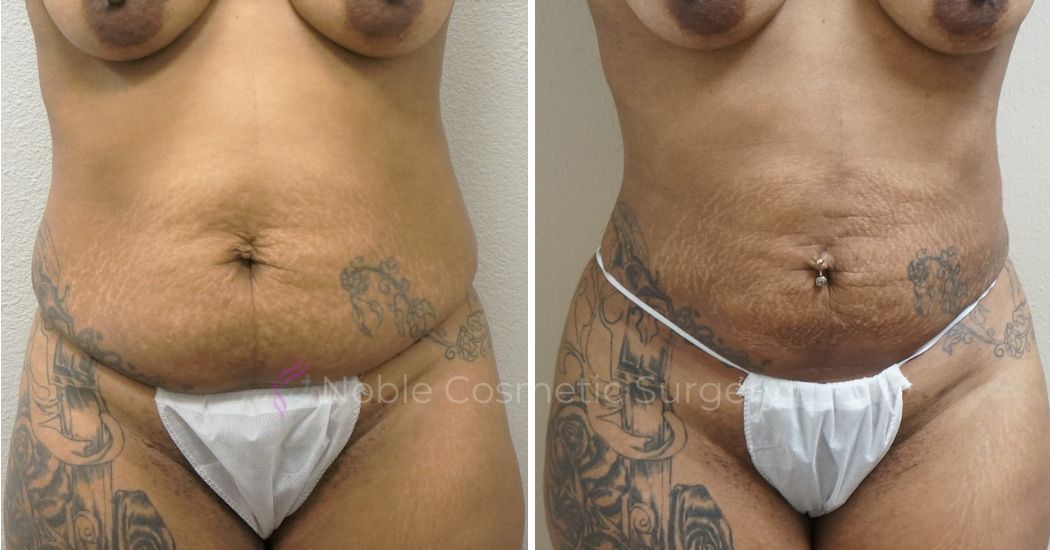 P3-00903L | Before and After Liposuction 1