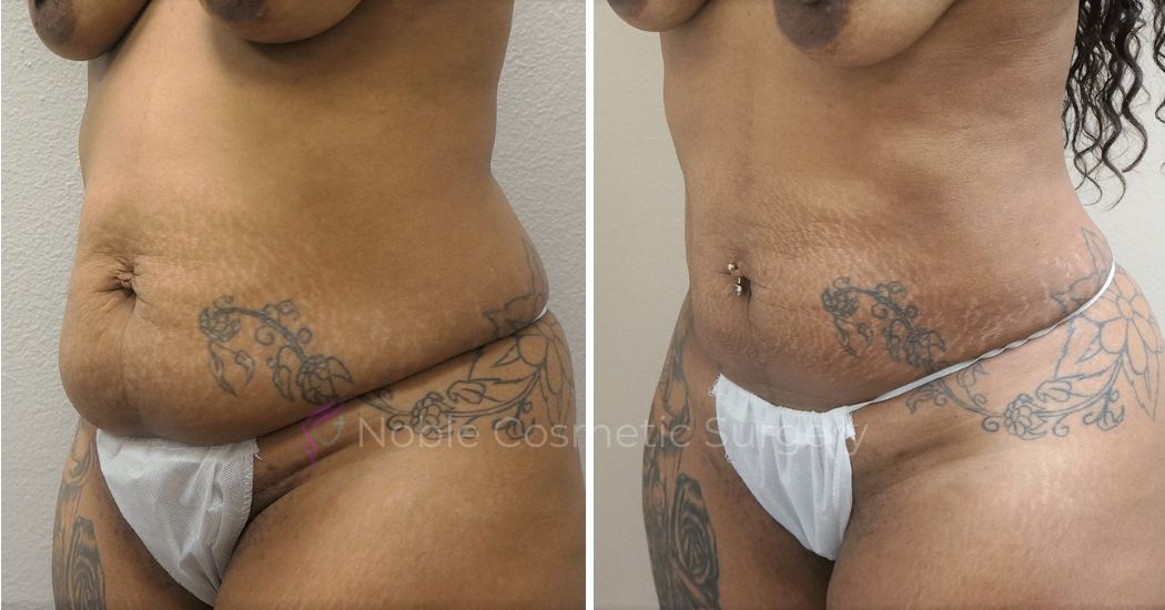 P3-00903L | Before and After Liposuction 2