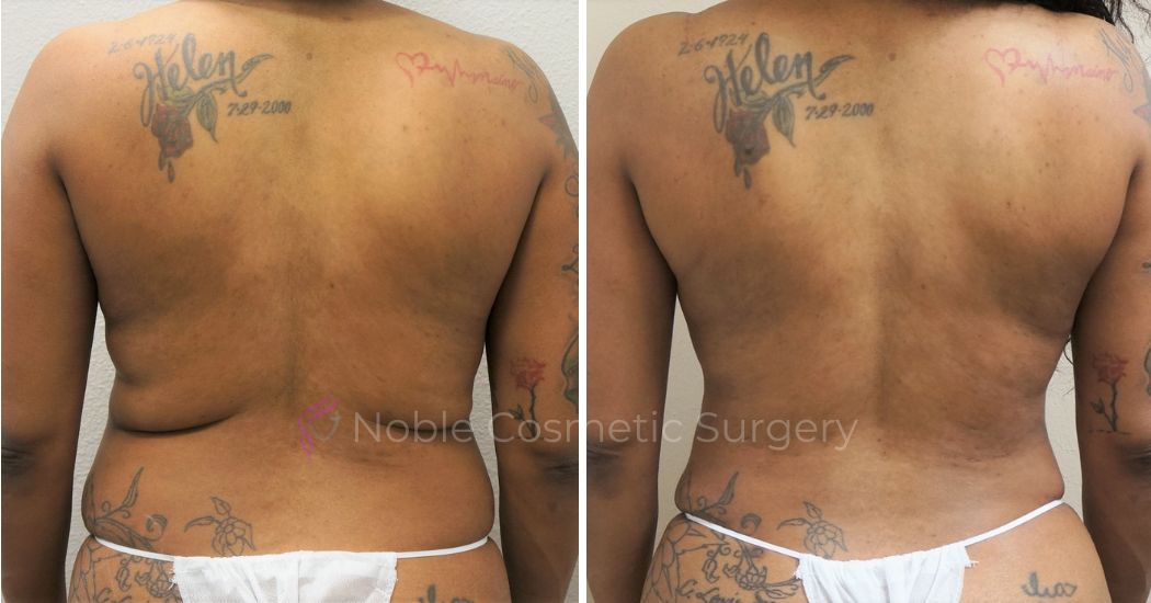 P3-00903L | Before and After Liposuction 3