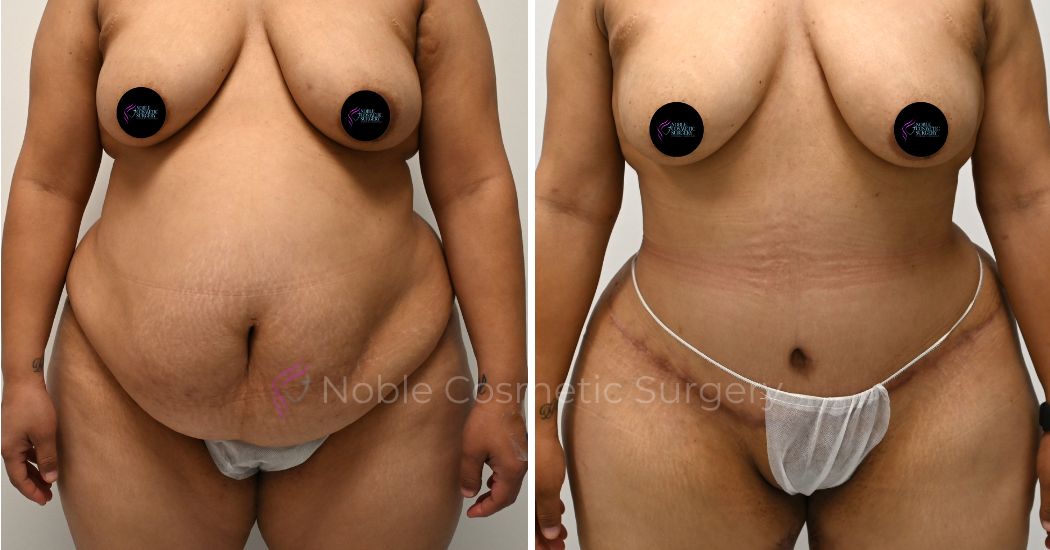 P30-00310A | Before and After Abdominoplasty 1