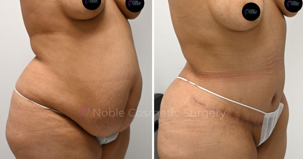 P30-00310A | Before and After Abdominoplasty 2