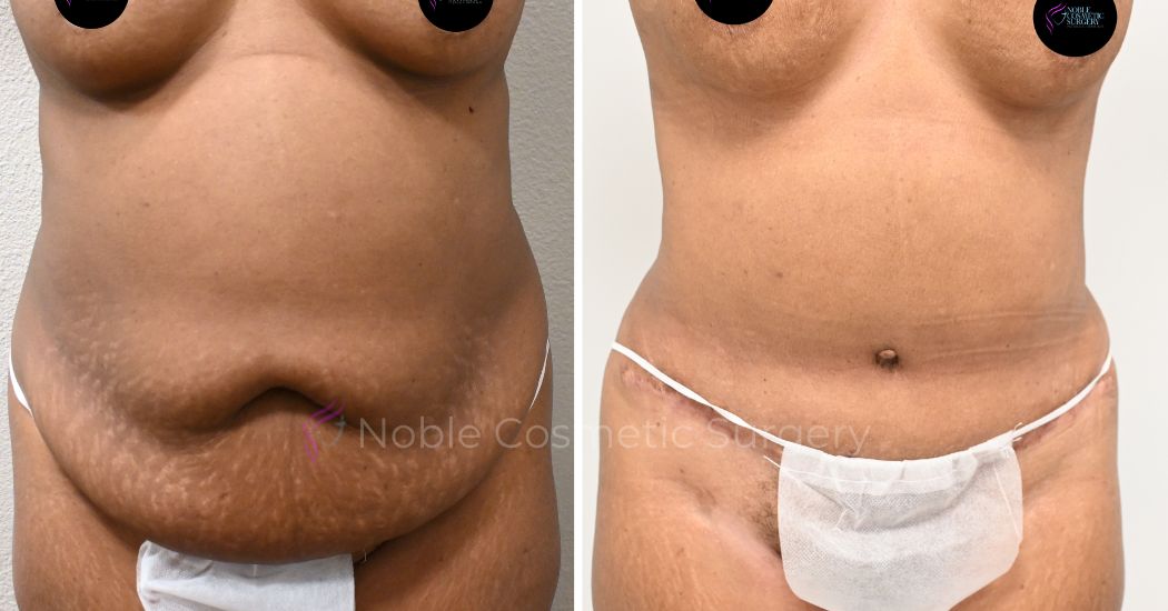 P30-00930L | Before and After Liposuction 1