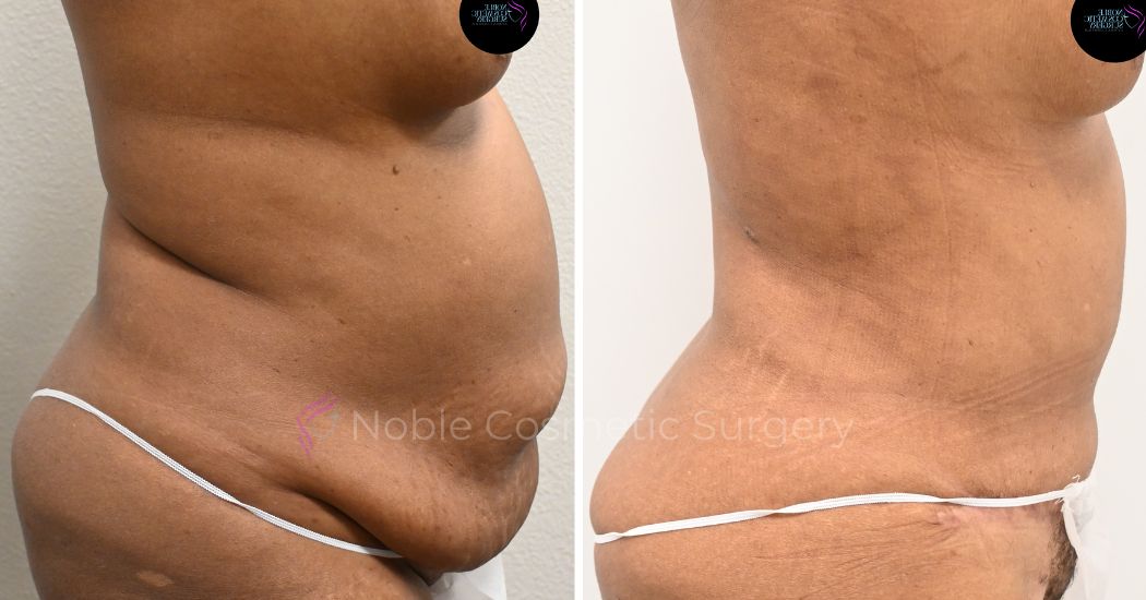 P30-00930L | Before and After Liposuction 2