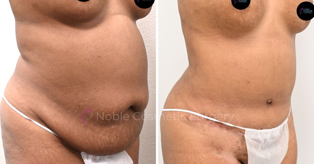 P30-00930L | Before and After Liposuction 3