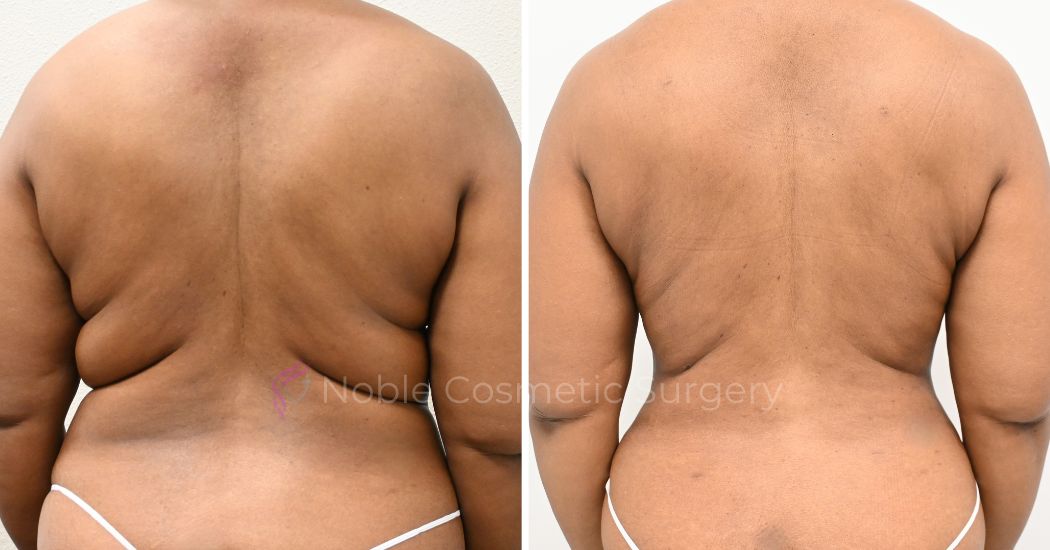 P30-00930L | Before and After Liposuction 4