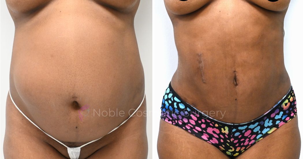 P31-00311A | Before and After Abdominoplasty 1