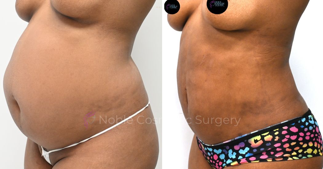 P31-00311A | Before and After Abdominoplasty 2