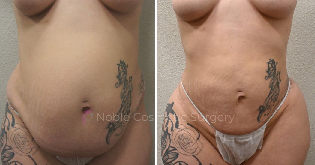 P31-00931L | Before and After Liposuction 1