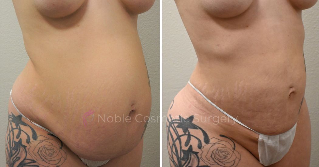 P31-00931L | Before and After Liposuction 2