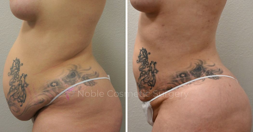 P31-00931L | Before and After Liposuction 3
