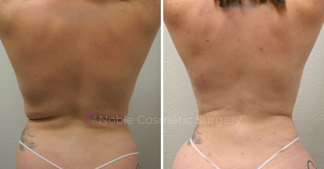 P31-00931L | Before and After Liposuction 4