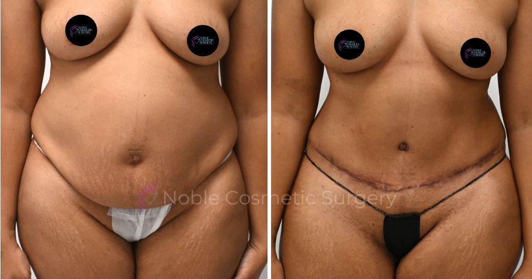 P32-00312A | Before and After Abdominoplasty 1