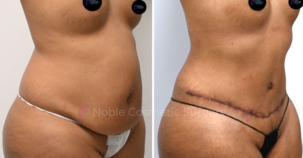 P32-00312A | Before and After Abdominoplasty 2