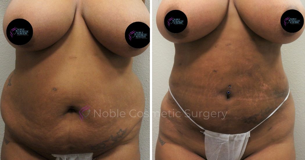P32-00932L | Before and After Liposuction 1