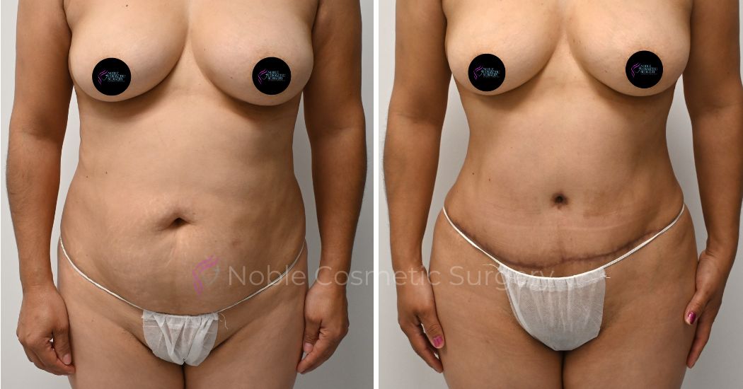 P33-00313A | Before and After Abdominoplasty 1