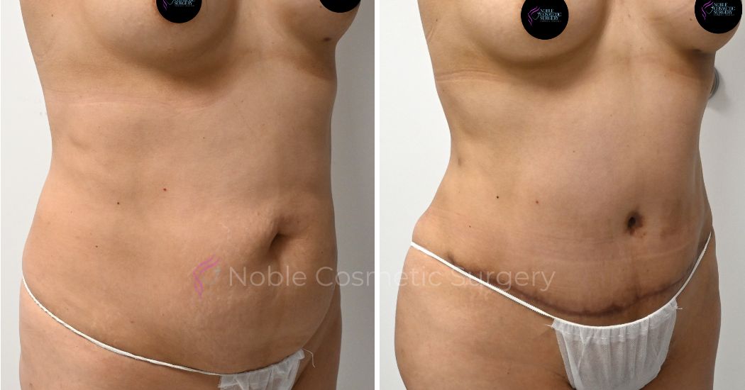 P33-00313A | Before and After Abdominoplasty 2
