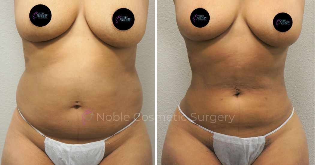 P33-00933L | Before and After Liposuction 1