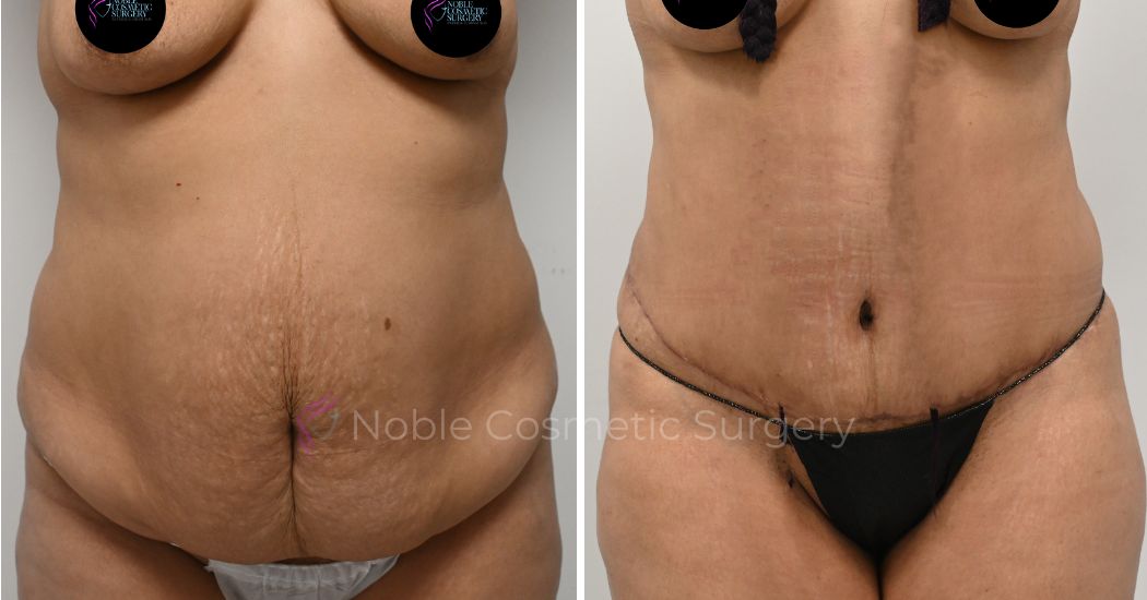 P34-00314A | Before and After Abdominoplasty 1