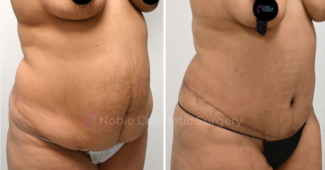 P34-00314A | Before and After Abdominoplasty 2