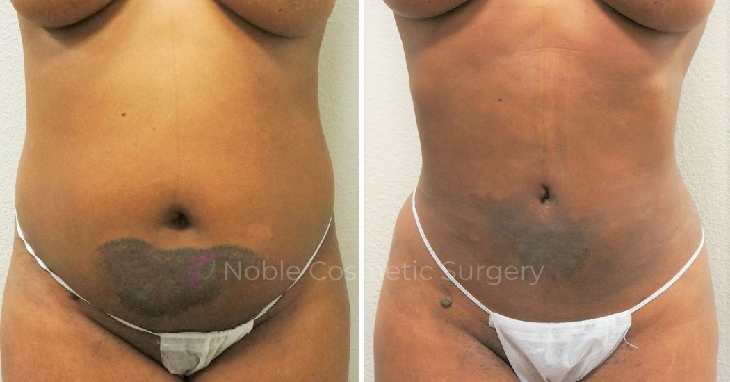 P34-00934L | Before and After Liposuction 1