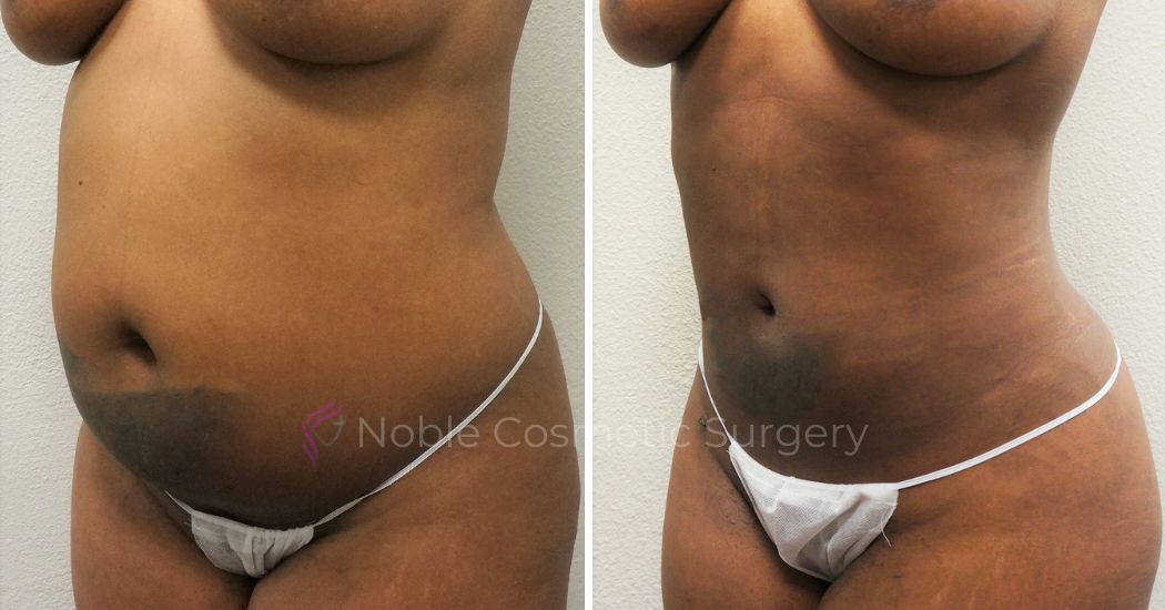 P34-00934L | Before and After Liposuction 2