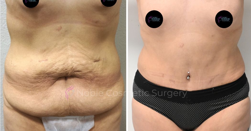 P35-00315A | Before and After Abdominoplasty 1