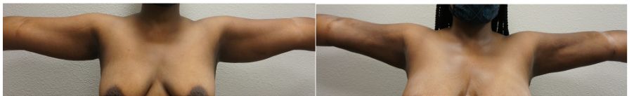Before and Aftar Arm Lift