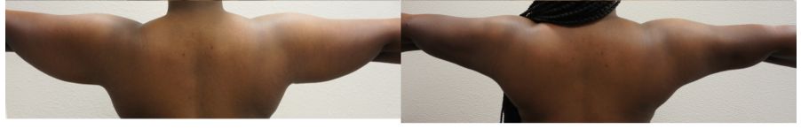 Before and After Arm Lift