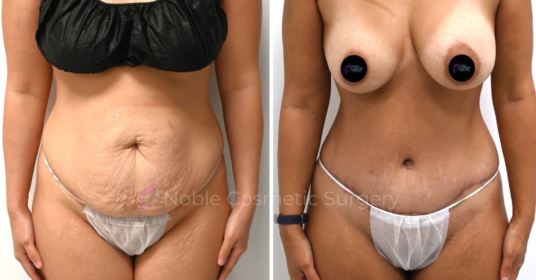 P36-00316A | Before and After Abdominoplasty 1