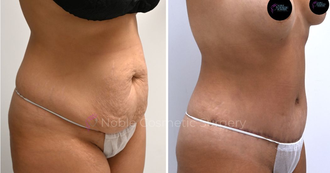 P36-00316A | Before and After Abdominoplasty 2