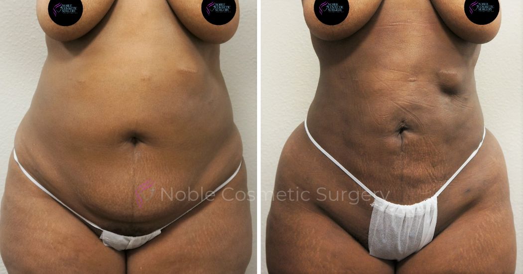 P36-00936L | Before and After Liposuction 1
