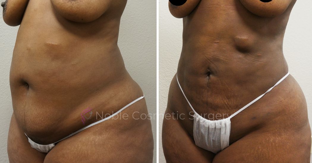 P36-00936L | Before and After Liposuction 2