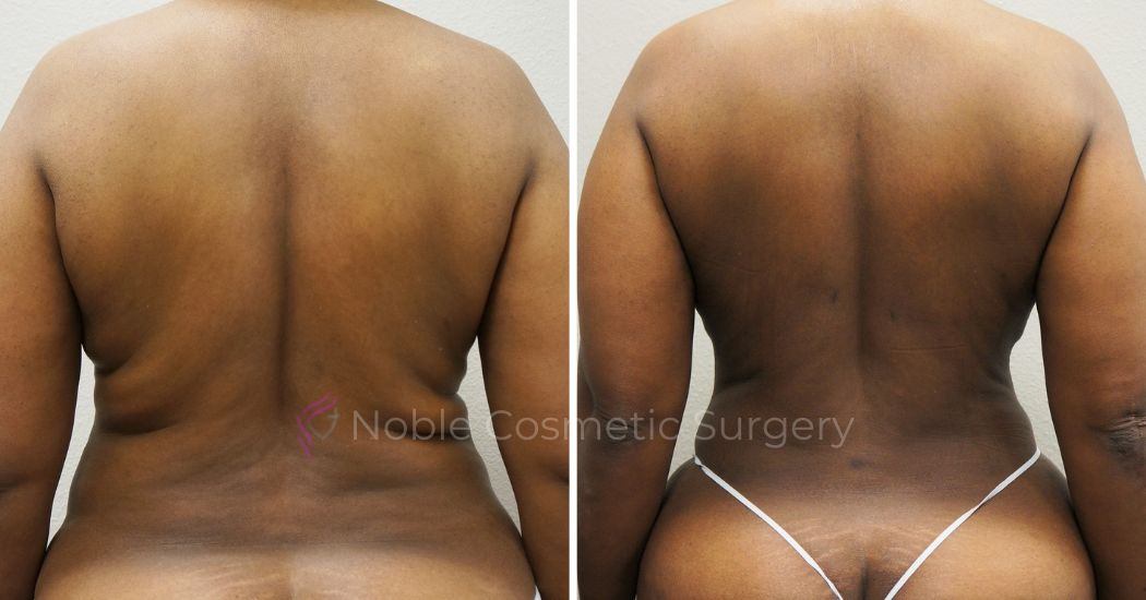 P36-00936L | Before and After Liposuction 3