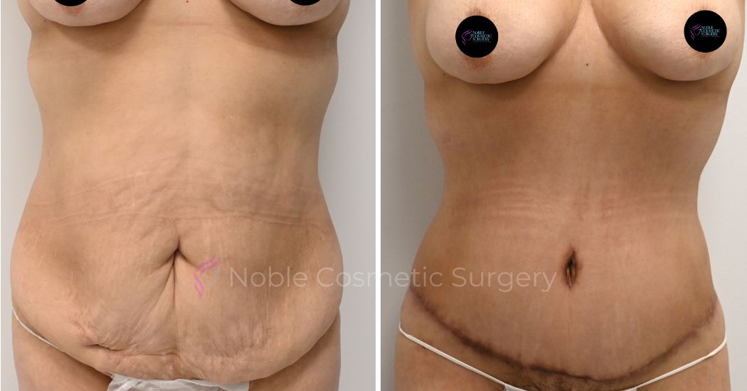 P37-00317A | Before and After Abdominoplasty 1