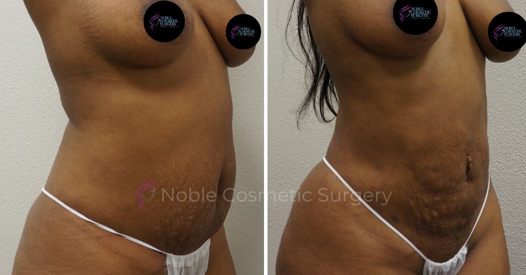 P37-00937L | Before and After Liposuction 2