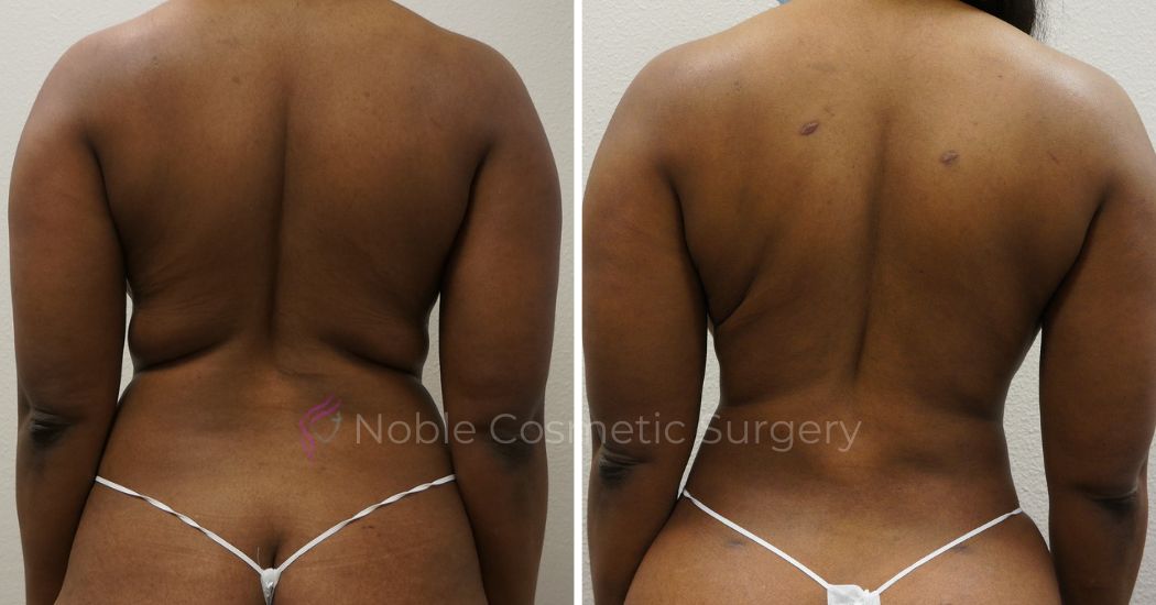 P37-00937L | Before and After Liposuction 3