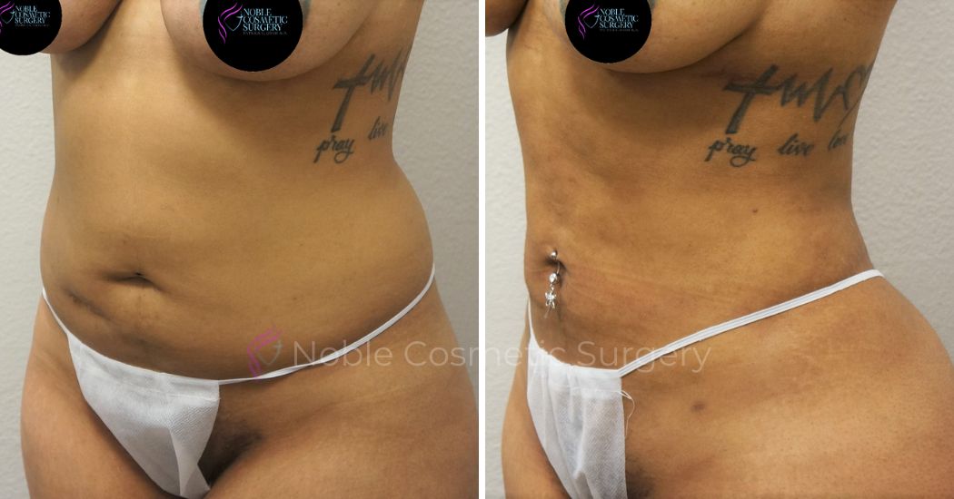 P38-00938L | Before and After Liposuction 2
