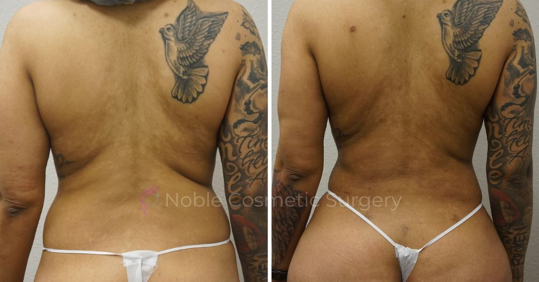 P38-00938L | Before and After Liposuction 3