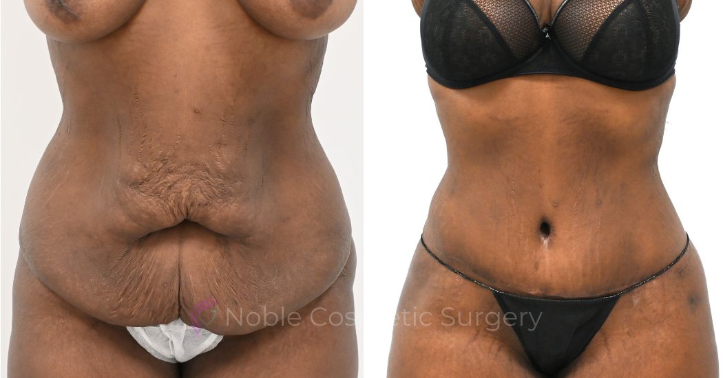 P39-00319A | Before and After Abdominoplasty 1