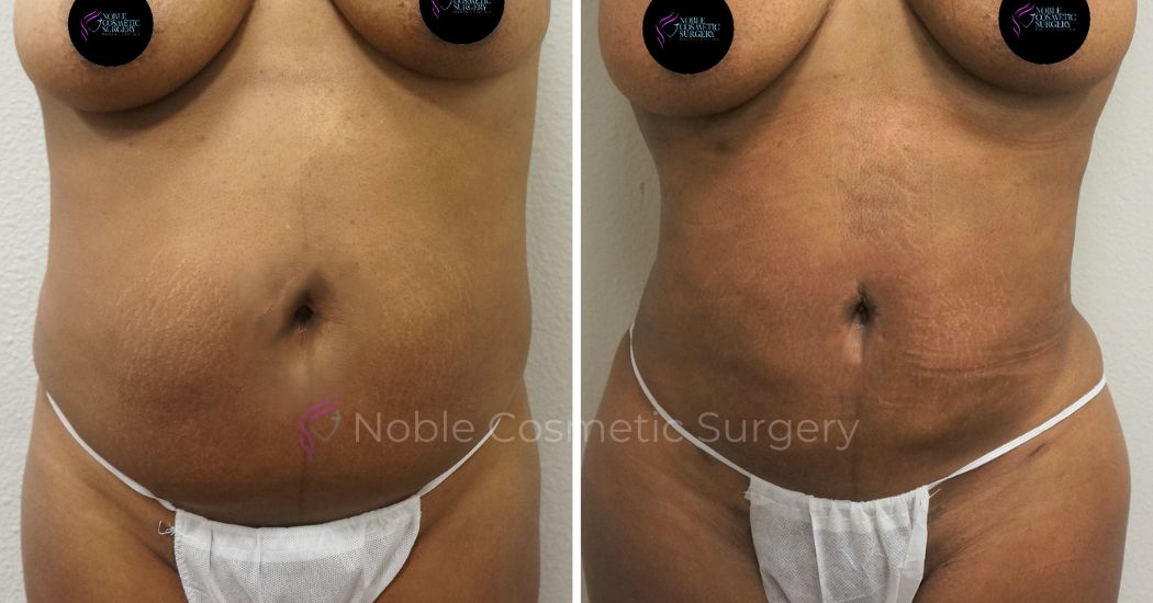 P39-00939L | Before and After Liposuction 1