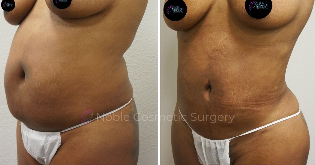 P39-00939L | Before and After Liposuction 2