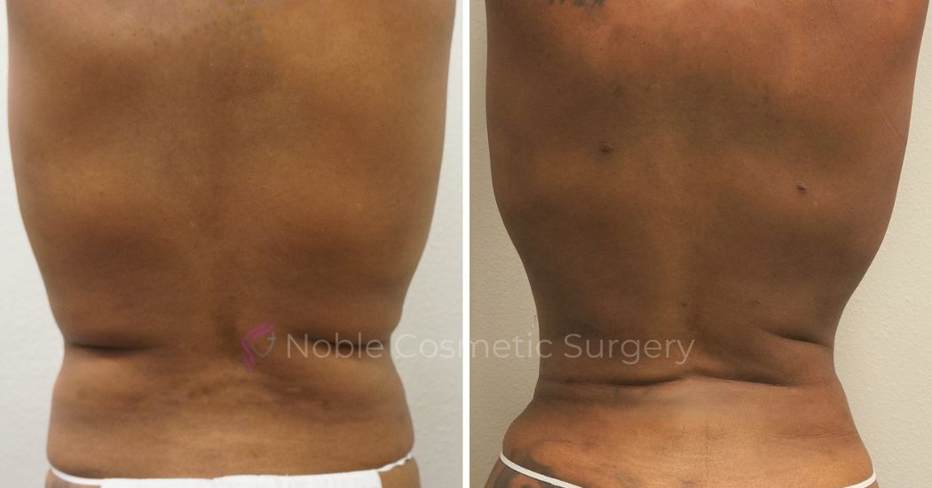 P39-00939L | Before and After Liposuction 3