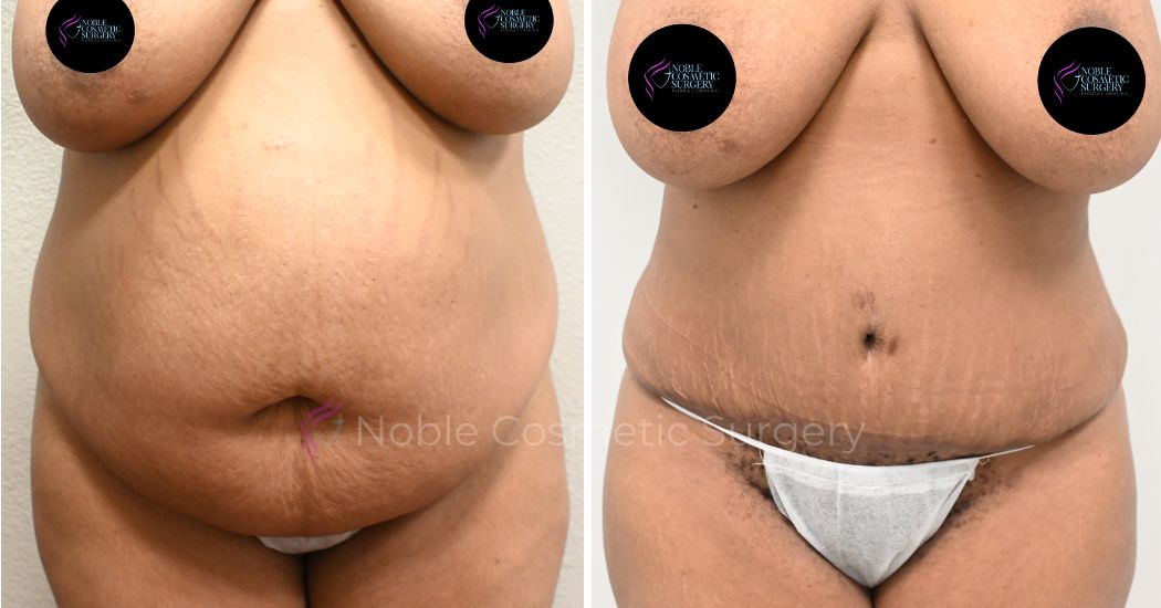 00035 | Before and After Abdominoplasty 1
