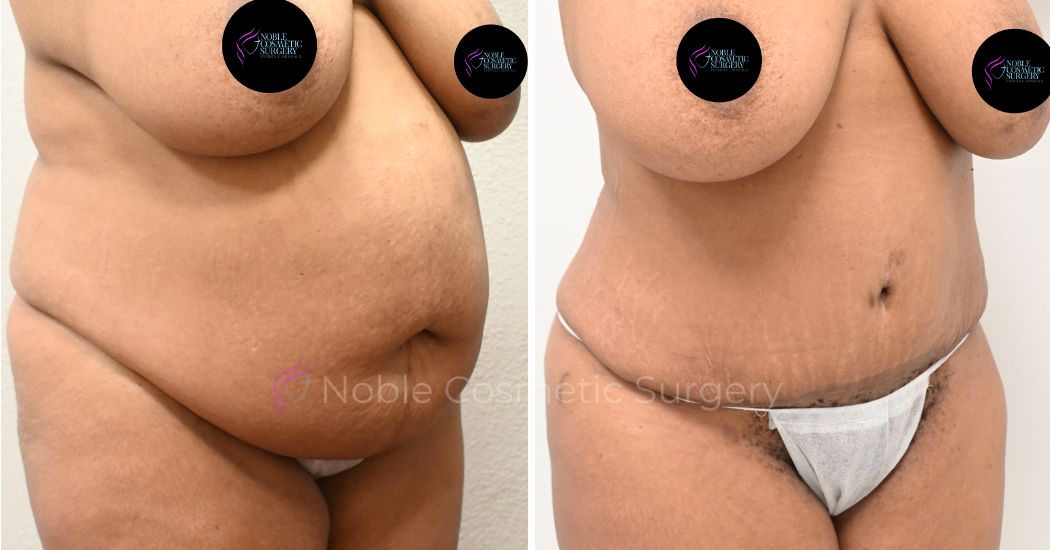 00035 | Before and After Abdominoplasty 2
