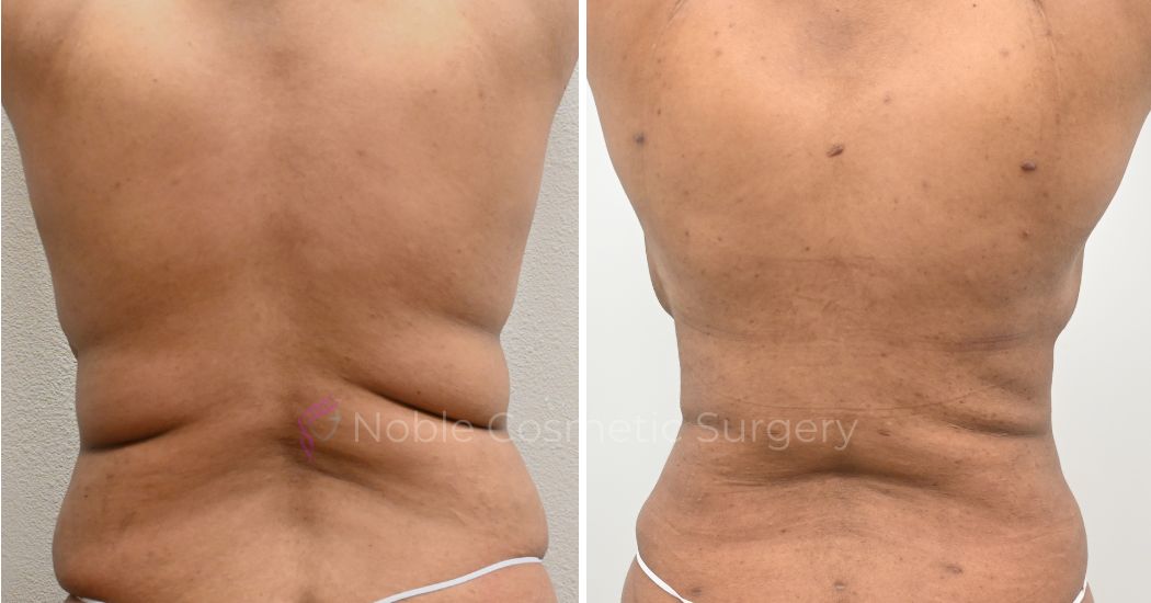00035 | Before and After Abdominoplasty 3