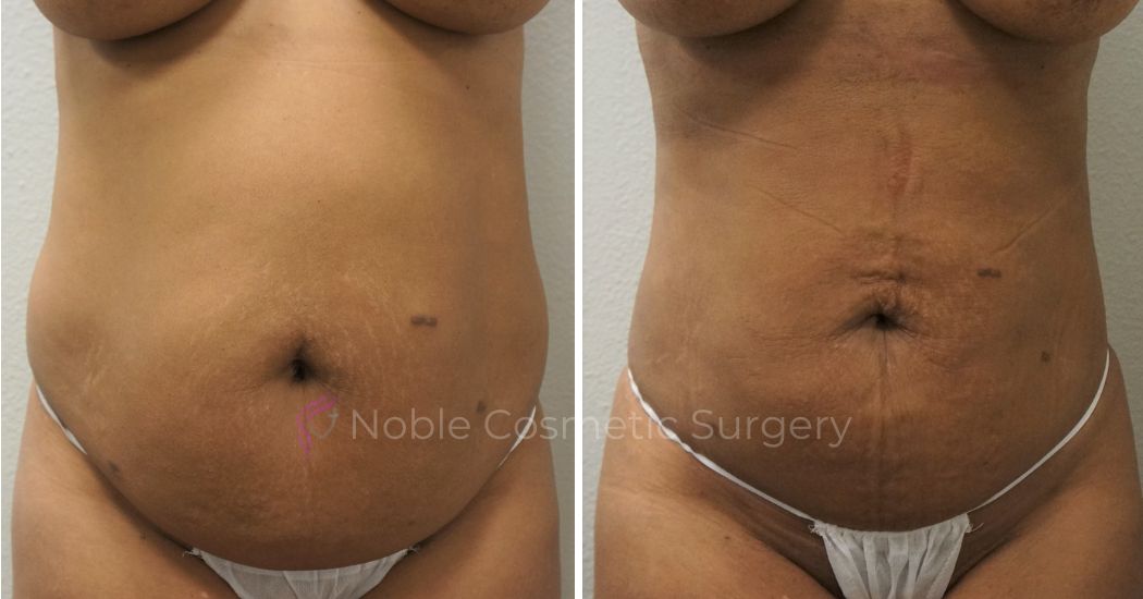 P4-00904L | Before and After Liposuction 1