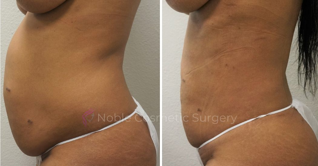 P4-00904L | Before and After Liposuction 2