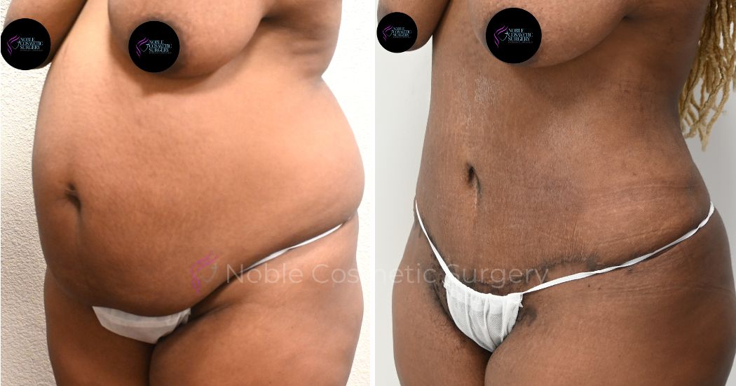 P40-00320A | Before and After Abdominoplasty 1