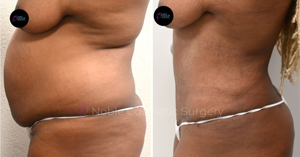 P40-00320A | Before and After Abdominoplasty 2