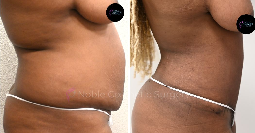 P40-00320A | Before and After Abdominoplasty 3